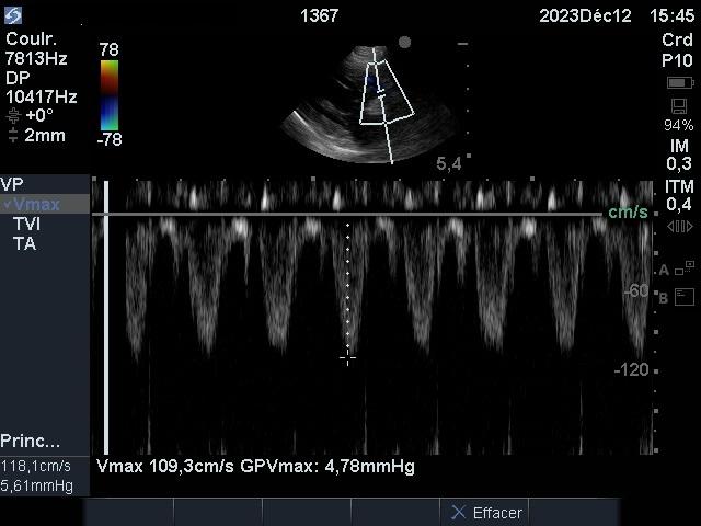 Echok flux pulmonaire